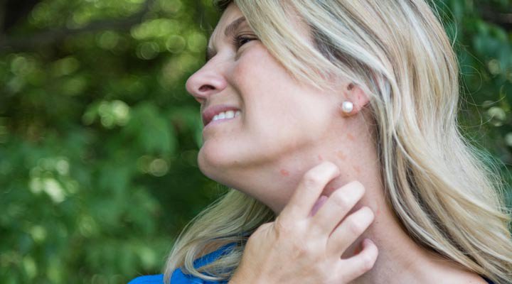 خواص درمانی عسل برای جوش صورت - درصور تداشتن آلرژی به عسل استفاده از آن می‌تواند موجب بروز کهیر یا بدترشدن جوش بشود.