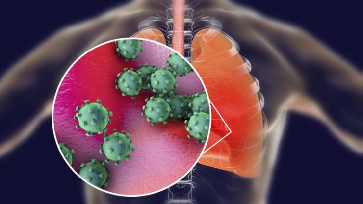 کاهش چشمگیر ظرفیت ریه بهبود یافتگان ویروس کرونا؛ آسیب‌های دائمی در راه است؟