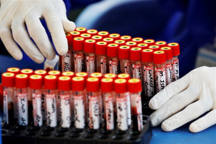 تحقیقات جدید احتمال تاثیر گروه خونی بر وخامت بیماری کرونا را قوت بخشید