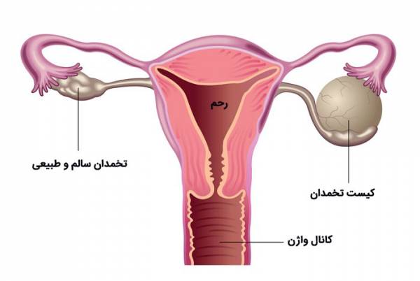 رشد کیست تخمدان