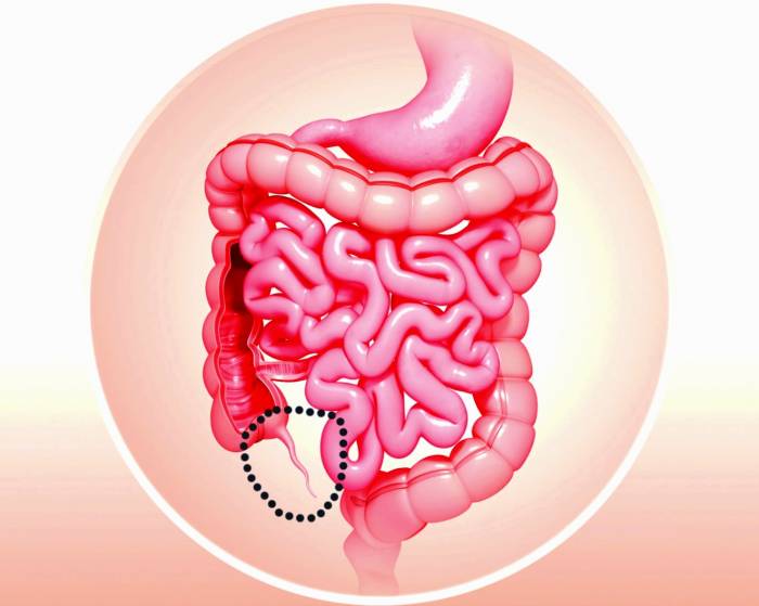 علائم آپاندیس