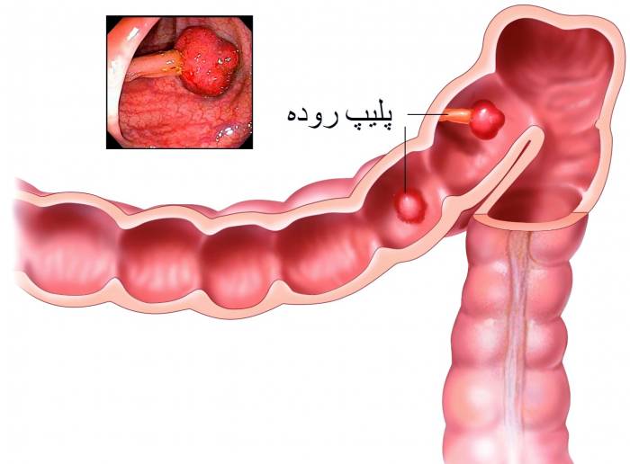 پولیپ روده