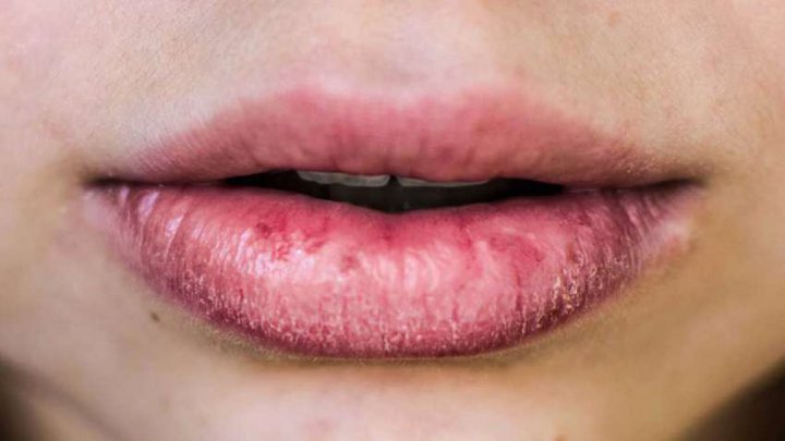 راهکار&zwnj;هایی برای رفع خشکی پوست و لب روزه داران