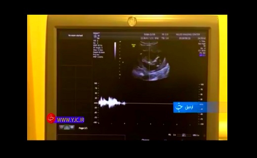 زایمان طبیعی یا سزارین؟!+فیلم