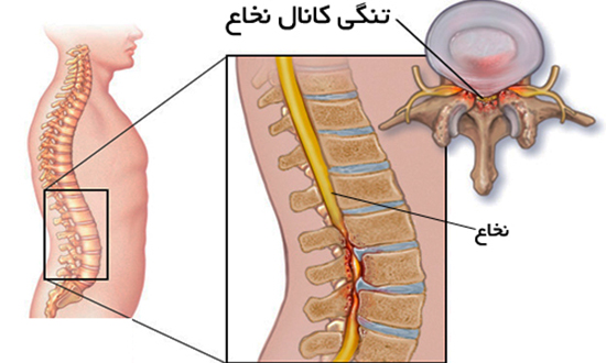 اگر با راه‌رفتن و ایستادن کمردرد می‌گیرید بخوانید!