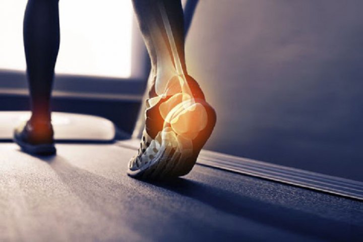 خار پاشنه پا چیست چه علائمی دارد و چگونه درمان می شود؟