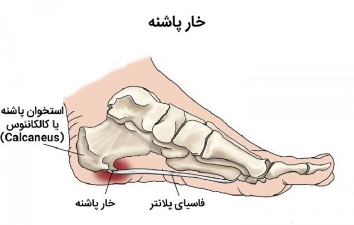 هرآنچه درباره خار پاشنه پا باید بدانید