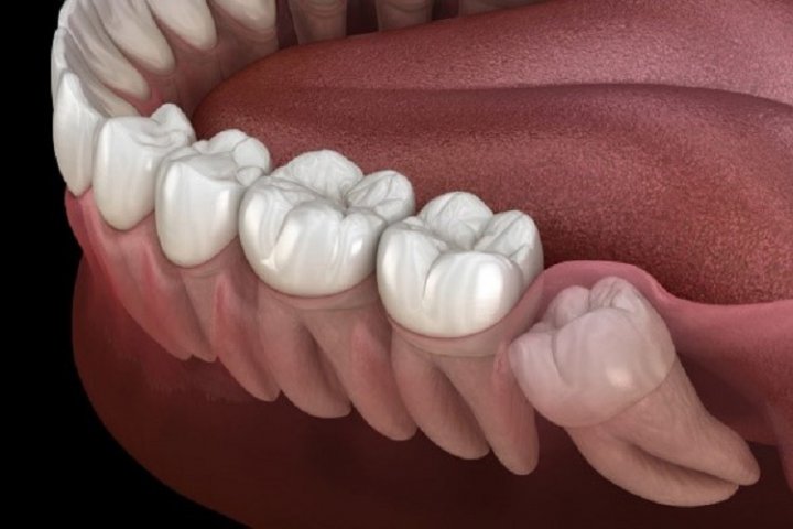 همه چیز درباره دندان عقل؛ از انواع دندان عقل تا زمان مناسب کشیدن
