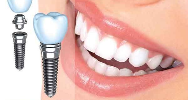 از جایگزینی دندان ها غافل نشوید! مضرات عدم اصلاح جای خالی دندان