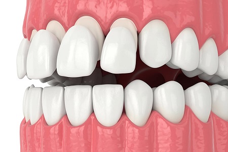 کامپوزیت دندان چیست و چه عواملی باعث لق شدن کامپوزیت می شود؟