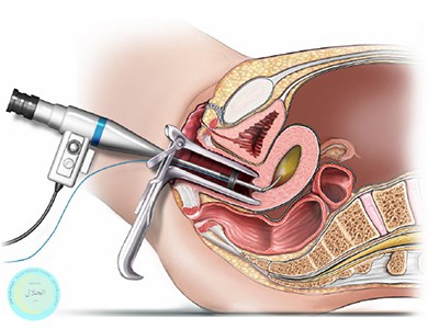 هیستروسکوپی تشخیصی درمانی