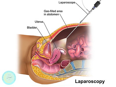 جراحی لاپاراسکوپی چیست