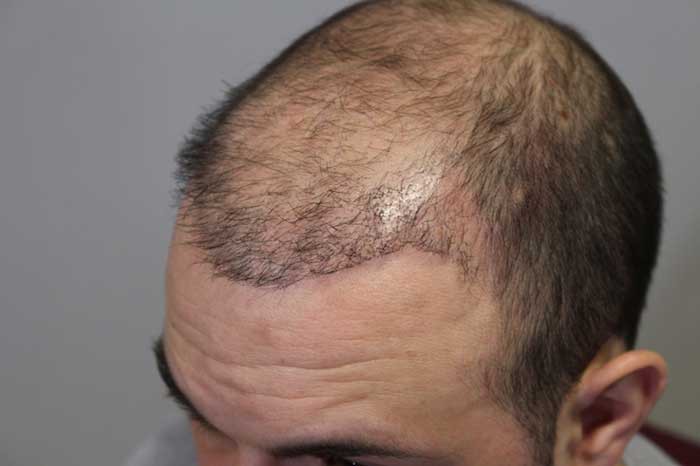 Under what conditions is hair transplant possible with a weak hair bank