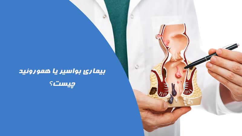 بواسیر چیست؟ علت و علائم انواع هموروئید + راه تشخیص