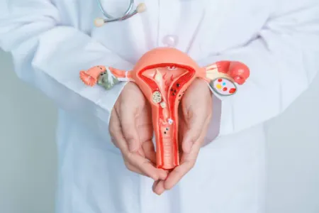 کوچک کردن فیبروم, فیبروم رحمی