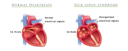 سندرم سینوس بیمار؛ بیماری قلبی که می تواند زندگی شما را تهدید کند