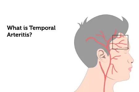 آرتریت تمپورال؛ سردردی که می تواند شما را زمین گیر کند