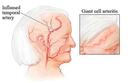 آرتریت تمپورال, تشخیص آرتریت تمپورال, آرتریت تمپورال چیست