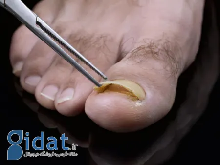 افتادن ناخن پا, سیاه شدن و افتادن ناخن پا