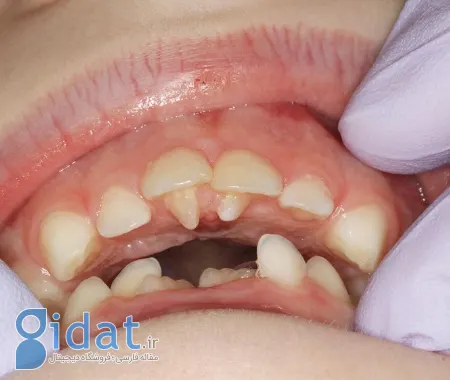 ناهنجاری های دندانی؛ از تشخیص تا درمان