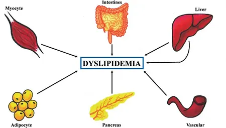 دیس لیپیدمی, علائم دیس لیپیدمی, عوارض جانبی بیماری دیس لیپیدمی