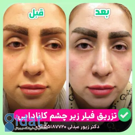 راهنمای جامع پرکننده زیر چشم Revanesse