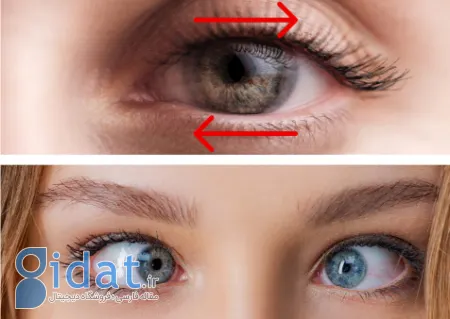 نیستاگموس: راز حرکات غیر ارادی چشم چیست؟