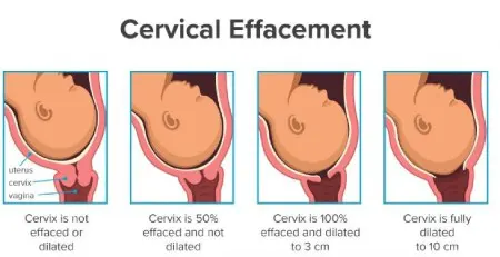 دیلاتاسیون سرویکس یا باز شدن دهانه رحم