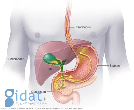 علل و علائم رفلاکس صفرا و راه های درمان آن