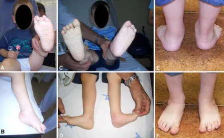 حرکات اصلاحی پای چابقی در کودکان