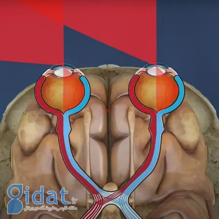 همیانوپیا چیست, همیانوپیا هم‌نام