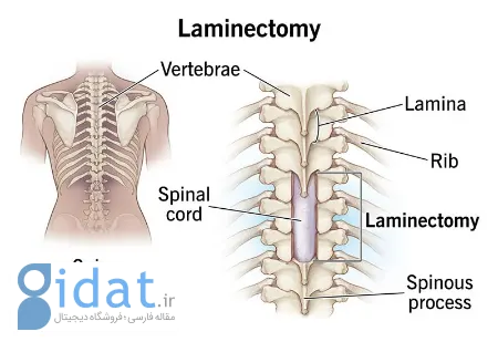 لامینکتومی, جراحی لامینکتومی
