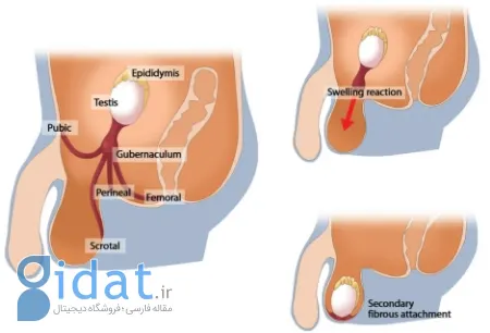 ارکیوپکسی چیست, عوارض ارکیوپکسی