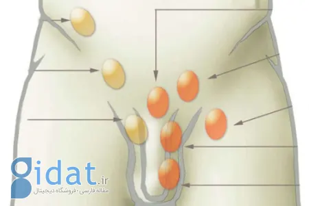 ارکیوپکسی چیست, عوارض ارکیوپکسی