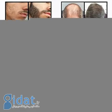 مفیدترین محصولات برای موهای نازک