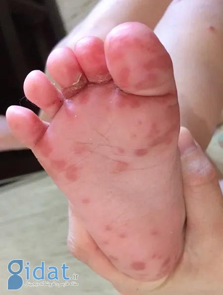 لکه‌های قرمز کف پا, بثورات پوستی پا