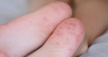 لکه‌های قرمز کف پا, بثورات پوستی پا