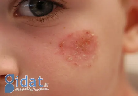 عفونت‌های باکتریایی پوست در کودکان