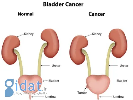 سرطان دستگاه ادراری؛ علل، علائم و راه های پیشگیری