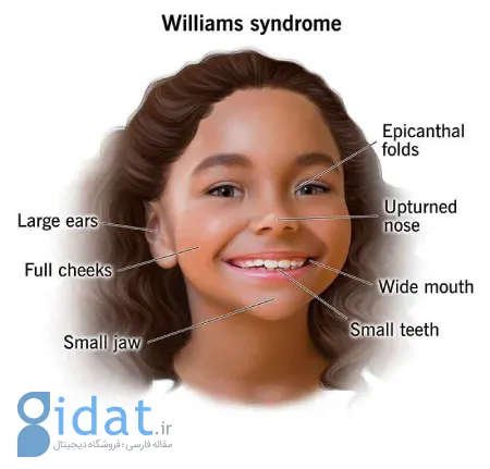 سندروم ویلیامز چیست