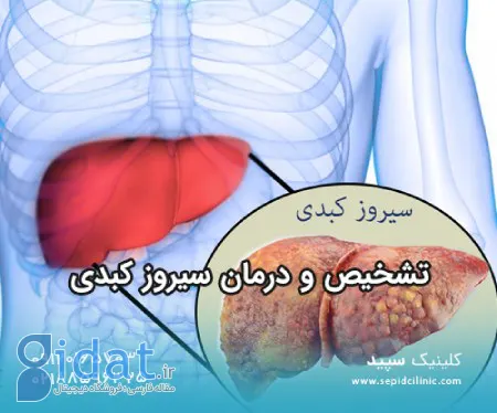 تشخیص و درمان سیروز کبدی با فیبرو اسکن