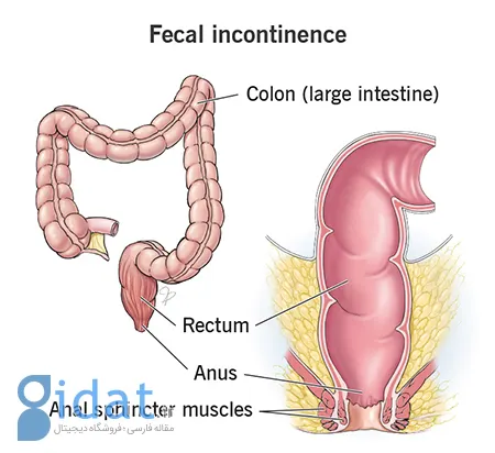 بی‌اختیاری مدفوع پس از زایمان, علائم بی‌اختیاری مدفوع