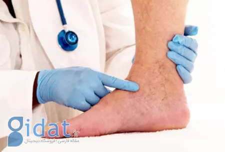 پیشگیری از لخته خون در پا, روش از بین بردن لخته خون