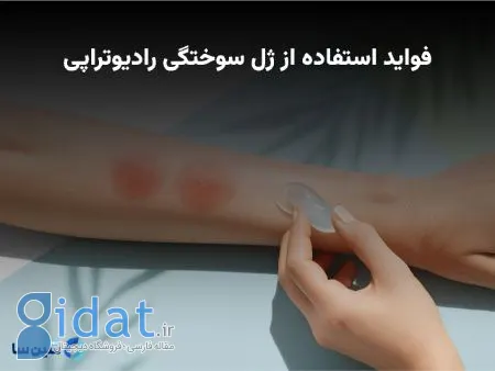 مزایای استفاده از ژل سوختگی رادیوتراپی برای بهبود عوارض