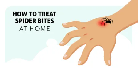 علائم نیش عنکبوت و روش های پیشگیری و درمان