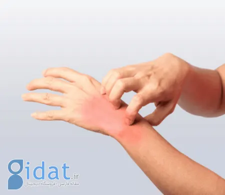 خارش انگشتان دست, درمان خارش انگشتان دست