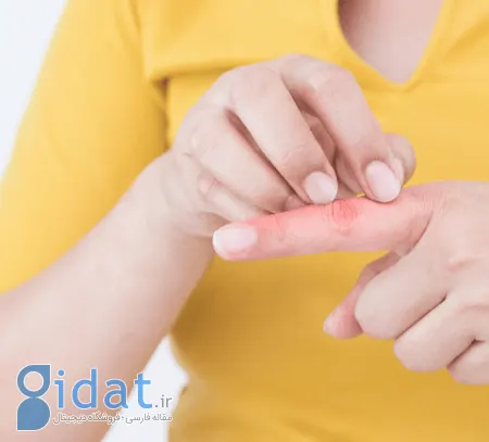 خارش انگشتان دست, درمان خارش انگشتان دست