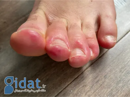 چیلبلین, چیلبلین دست