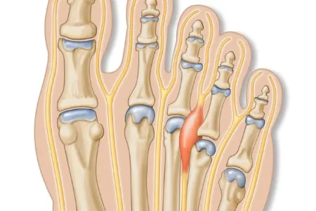 مشکلات رایج پا در افراد مسن, خستگی پا در افراد مسن