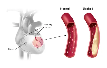 باز کردن رگ قلب, درمان طبیعی تصلب شرایین